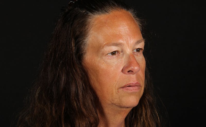 Blepharoplasty & Browlift Before & After Gallery - Patient 224767 - Image 3