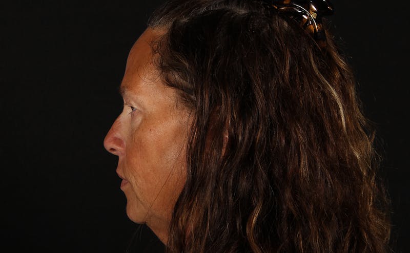 Blepharoplasty & Browlift Before & After Gallery - Patient 224767 - Image 9