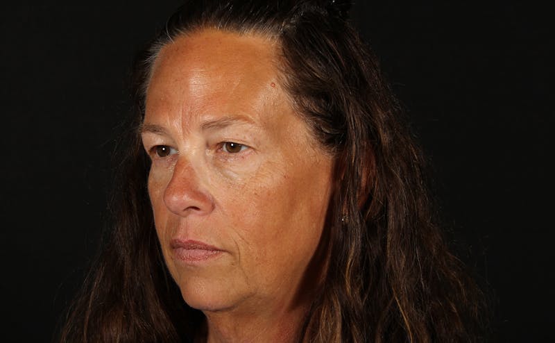 Blepharoplasty & Browlift Before & After Gallery - Patient 224767 - Image 7