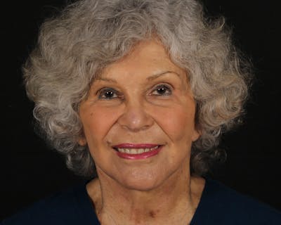 Face & Neck Lift Before & After Gallery - Patient 209170 - Image 2