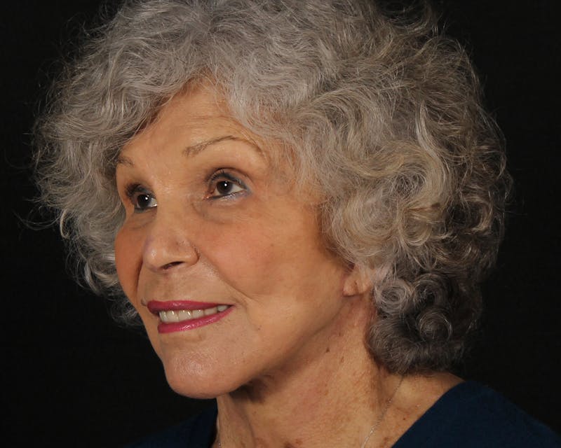 Face & Neck Lift Before & After Gallery - Patient 209170 - Image 8