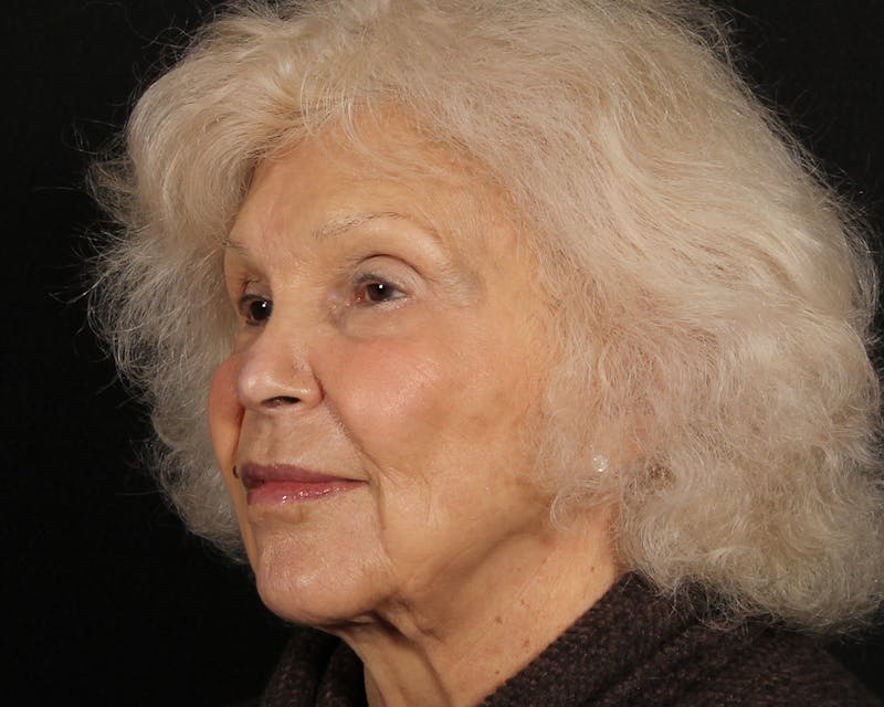 Face & Neck Lift Before & After Gallery - Patient 209170 - Image 7