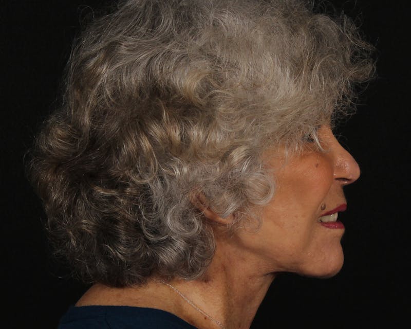 Face & Neck Lift Before & After Gallery - Patient 209170 - Image 6