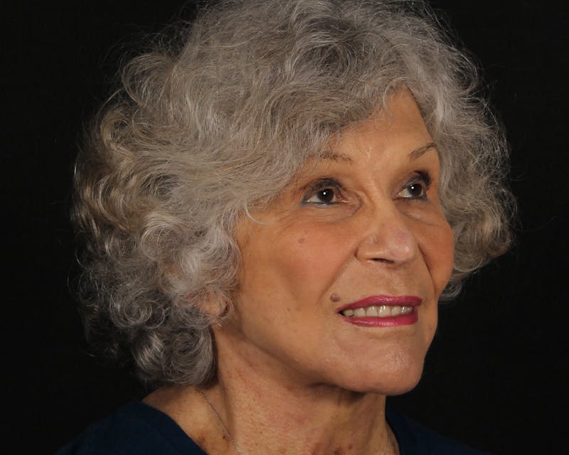 Face & Neck Lift Before & After Gallery - Patient 209170 - Image 4