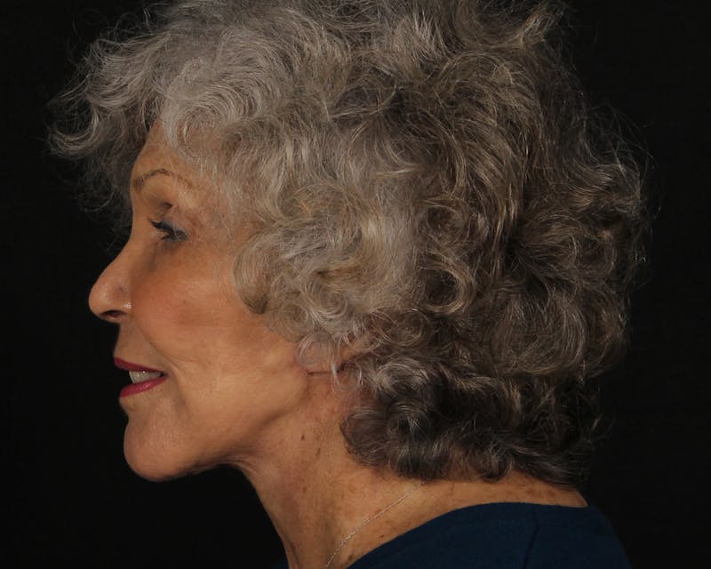 Face & Neck Lift Before & After Gallery - Patient 209170 - Image 10