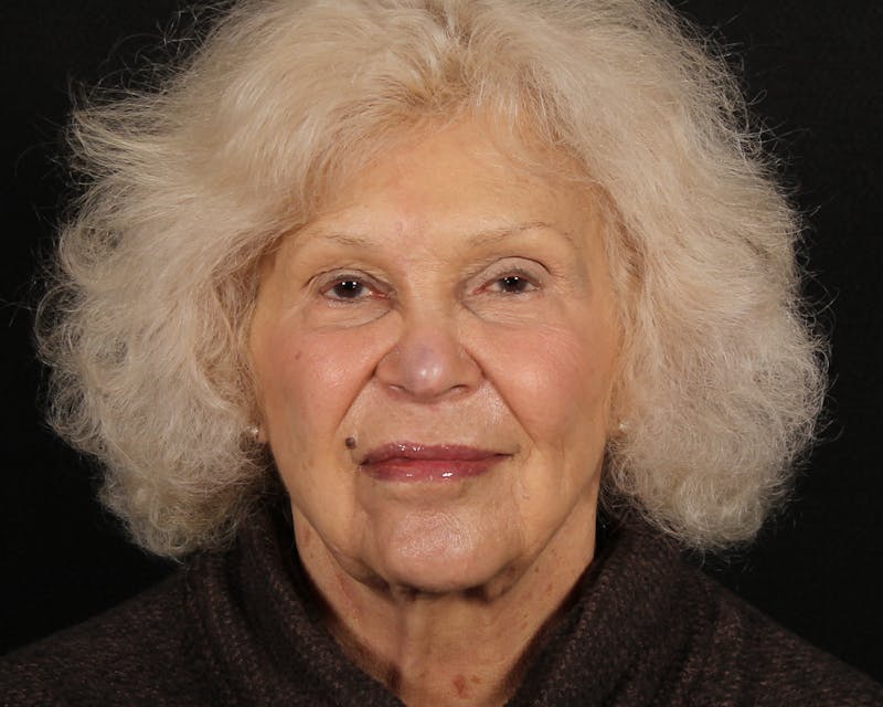 Face & Neck Lift Before & After Gallery - Patient 209170 - Image 1