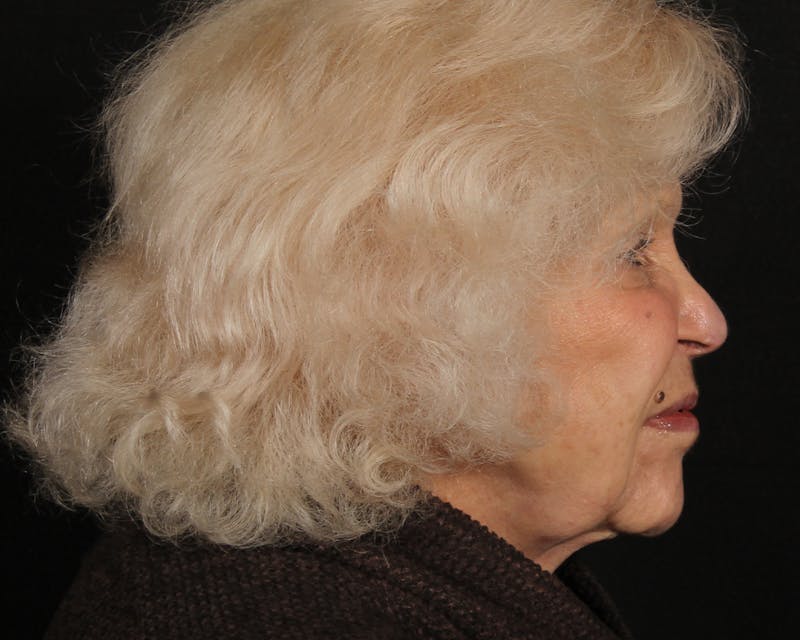 Face & Neck Lift Before & After Gallery - Patient 209170 - Image 5