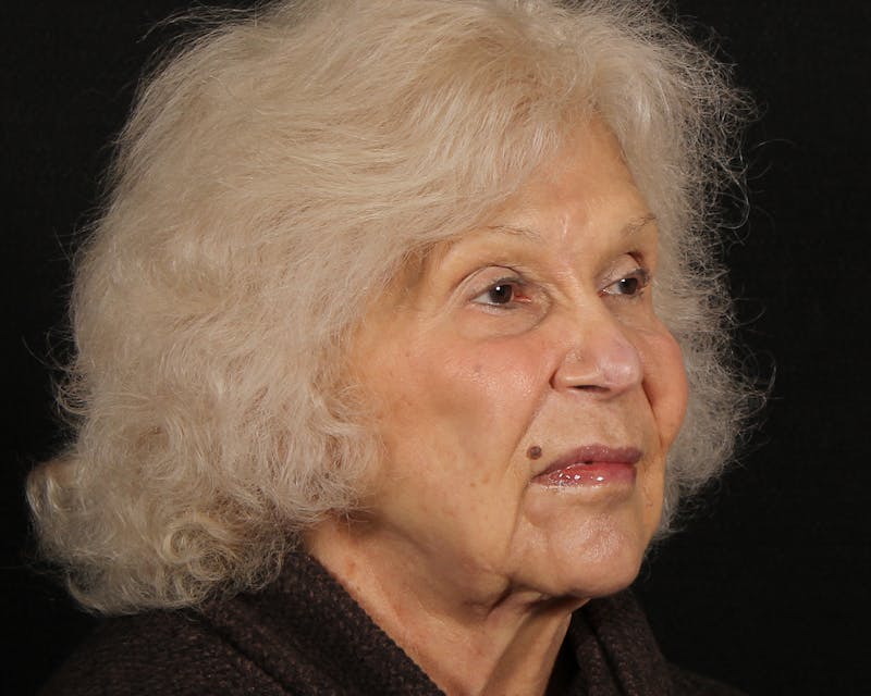 Face & Neck Lift Before & After Gallery - Patient 209170 - Image 3