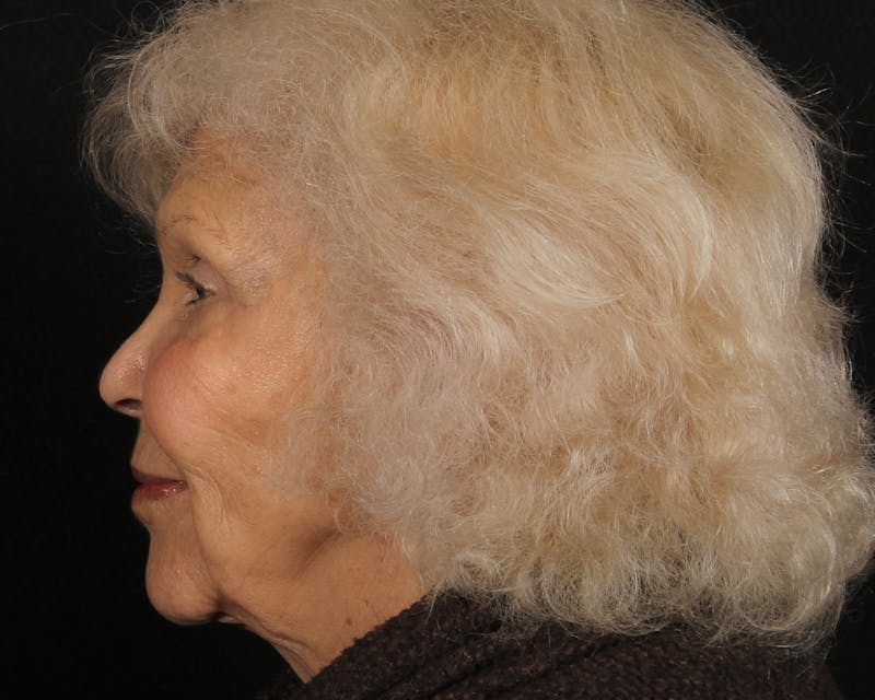 Face & Neck Lift Before & After Gallery - Patient 209170 - Image 9