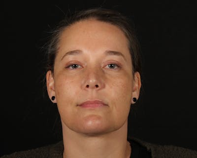 Face & Neck Lift Before & After Gallery - Patient 147493 - Image 2