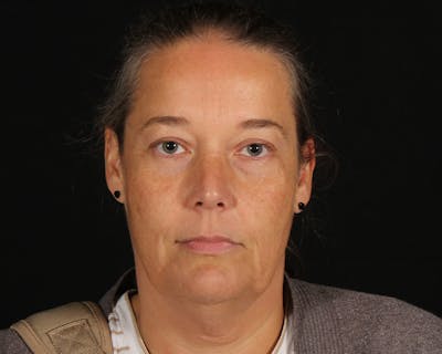Face & Neck Lift Before & After Gallery - Patient 147493 - Image 1