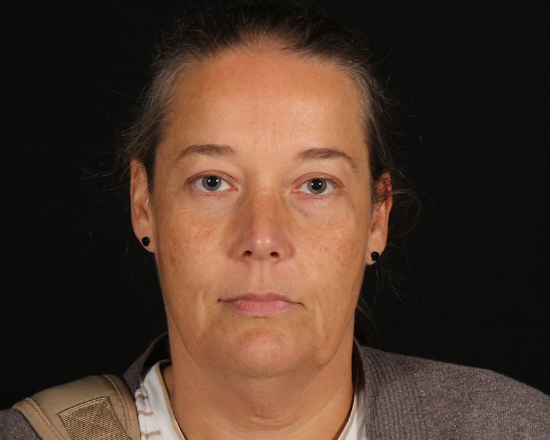 Face & Neck Lift Before & After Gallery - Patient 147493 - Image 1