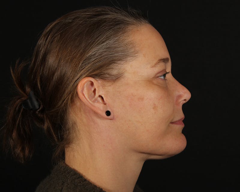 Face & Neck Lift Before & After Gallery - Patient 147493 - Image 6