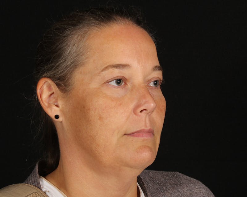 Face & Neck Lift Before & After Gallery - Patient 147493 - Image 3