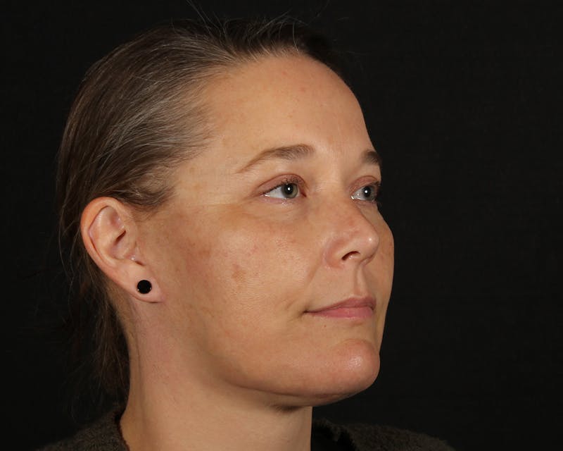 Face & Neck Lift Before & After Gallery - Patient 147493 - Image 4
