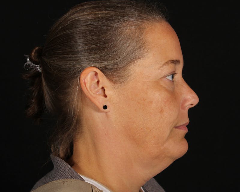 Face & Neck Lift Before & After Gallery - Patient 147493 - Image 5