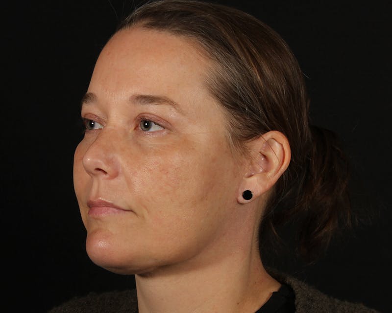 Face & Neck Lift Before & After Gallery - Patient 147493 - Image 8