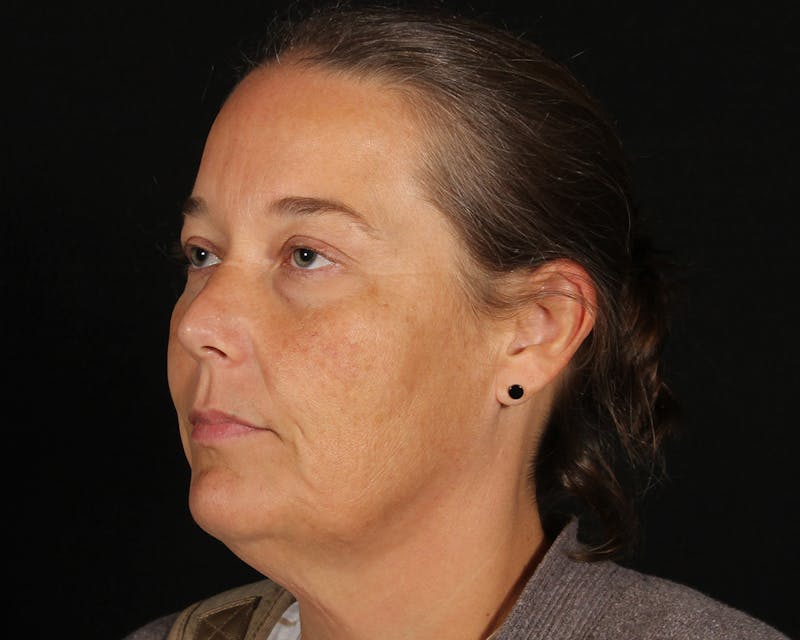 Face & Neck Lift Before & After Gallery - Patient 147493 - Image 7