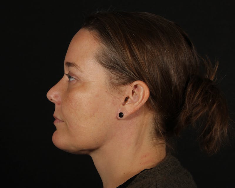 Face & Neck Lift Before & After Gallery - Patient 147493 - Image 10