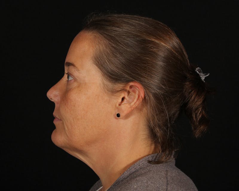 Face & Neck Lift Before & After Gallery - Patient 147493 - Image 9
