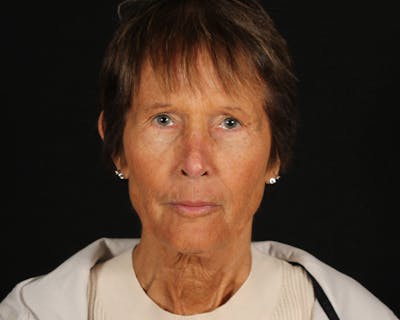 Face & Neck Lift Before & After Gallery - Patient 907652 - Image 1