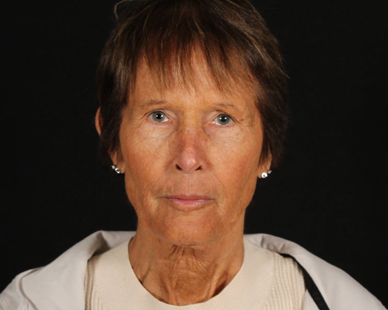 Face & Neck Lift Before & After Gallery - Patient 907652 - Image 1