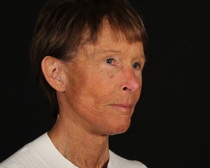 Face & Neck Lift Before & After Gallery - Patient 907652 - Image 4