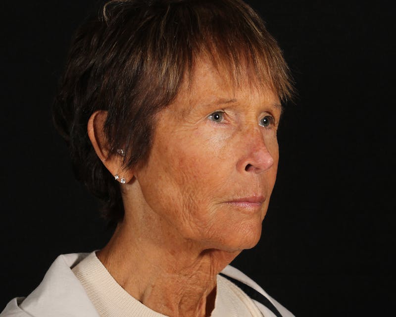 Face & Neck Lift Before & After Gallery - Patient 907652 - Image 3