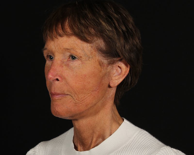 Face & Neck Lift Before & After Gallery - Patient 907652 - Image 6