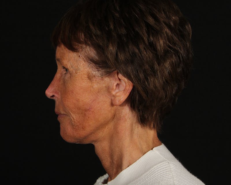 Face & Neck Lift Before & After Gallery - Patient 907652 - Image 8
