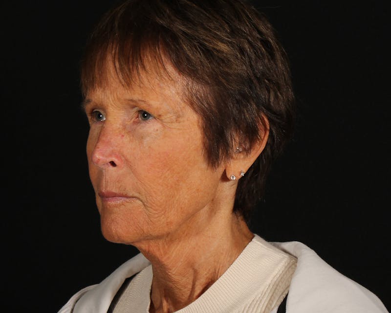 Face & Neck Lift Before & After Gallery - Patient 907652 - Image 5