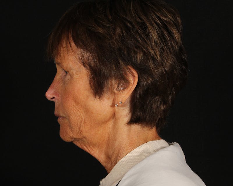 Face & Neck Lift Before & After Gallery - Patient 907652 - Image 7