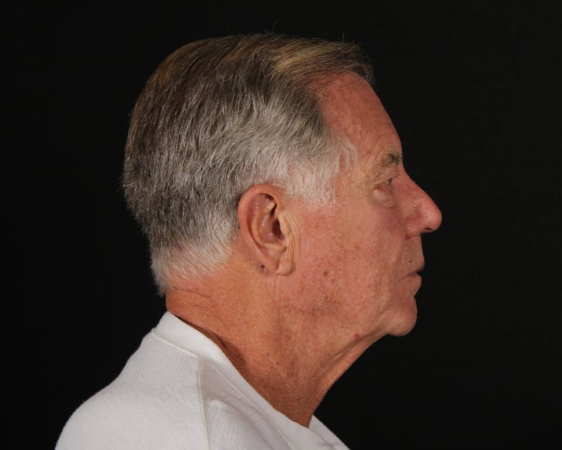Laser Treatments Before & After Gallery - Patient 409738 - Image 3
