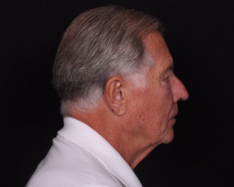 Laser Treatments Before & After Gallery - Patient 409738 - Image 4