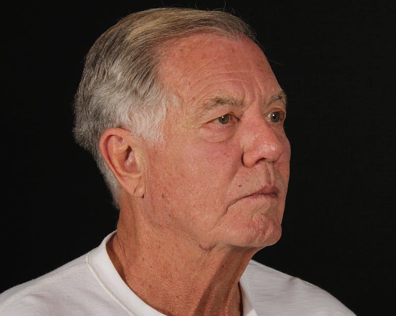 Laser Treatments Before & After Gallery - Patient 409738 - Image 6