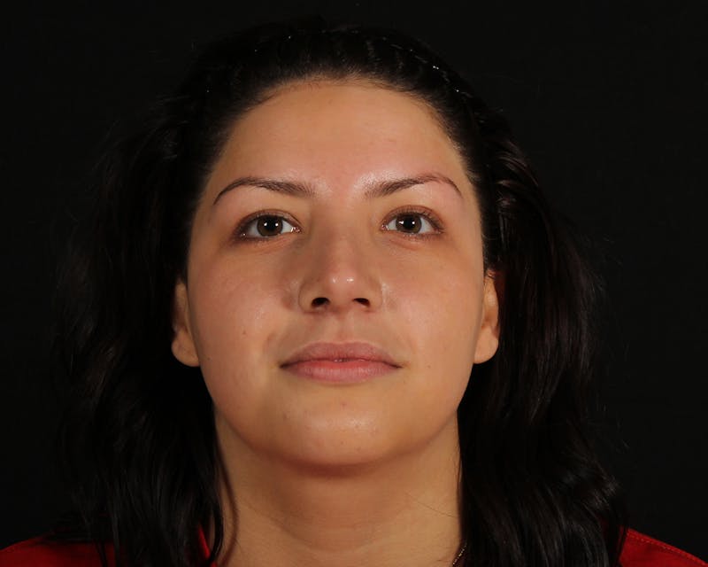 Rhinoplasty Female Before & After Gallery - Patient 316760 - Image 6