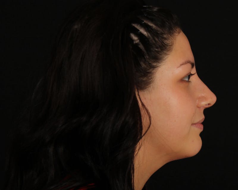 Rhinoplasty Female Before & After Gallery - Patient 316760 - Image 12