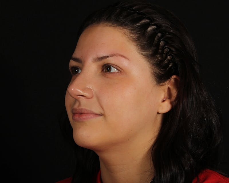 Rhinoplasty Female Before & After Gallery - Patient 316760 - Image 4