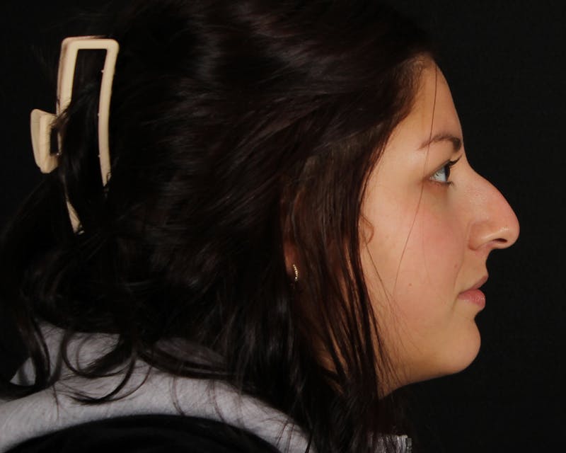 Rhinoplasty Female Before & After Gallery - Patient 316760 - Image 11