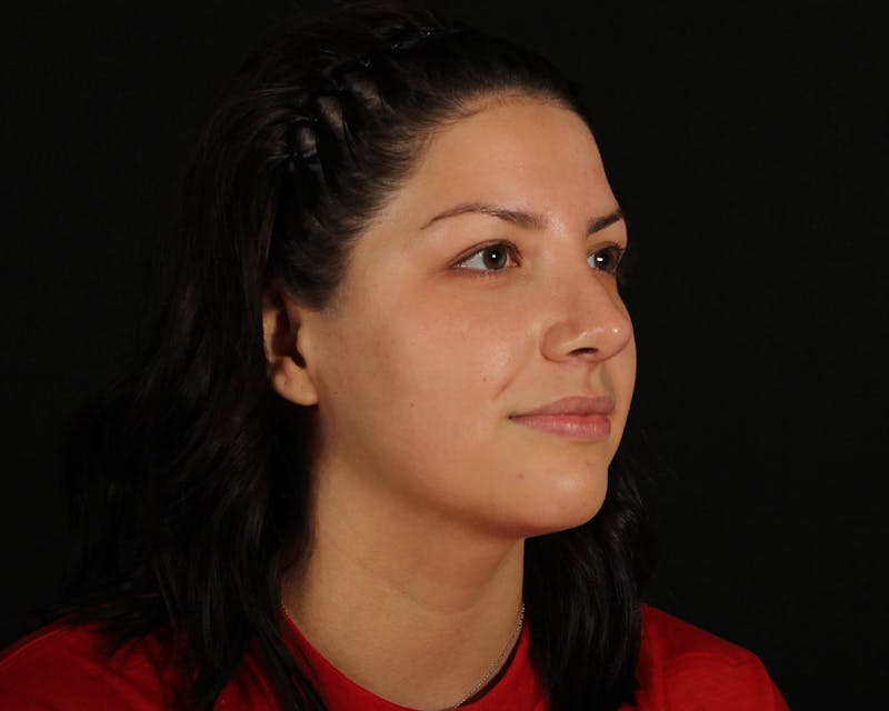 Rhinoplasty Female Before & After Gallery - Patient 316760 - Image 10