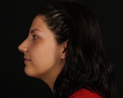 Rhinoplasty Female Before & After Gallery - Patient 316760 - Image 2