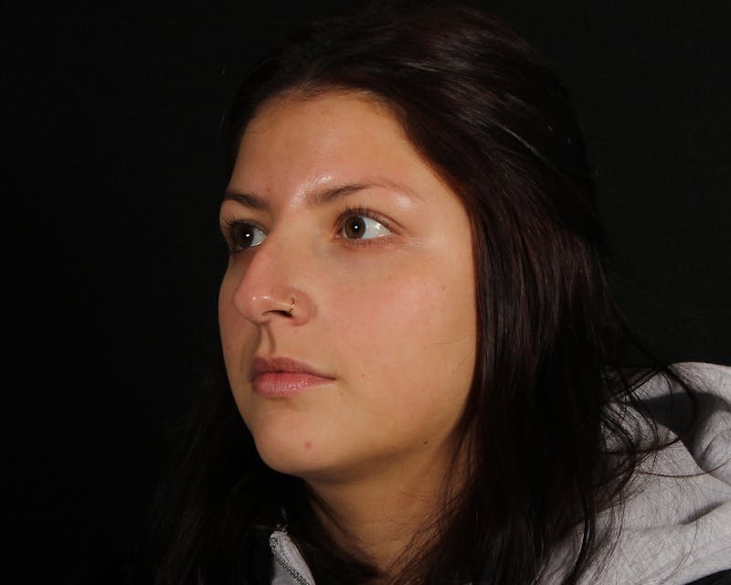 Rhinoplasty Female Before & After Gallery - Patient 316760 - Image 3