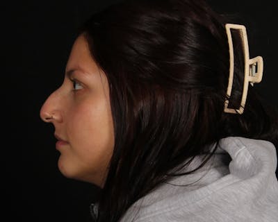 Rhinoplasty Female Before & After Gallery - Patient 316760 - Image 1