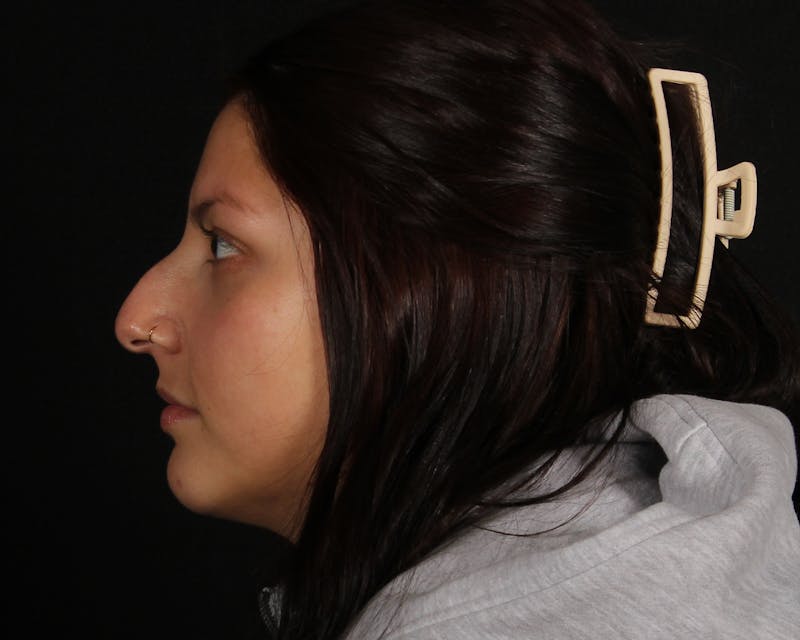 Rhinoplasty Female Before & After Gallery - Patient 316760 - Image 1