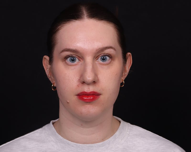 Rhinoplasty Female Before & After Gallery - Patient 378577 - Image 5