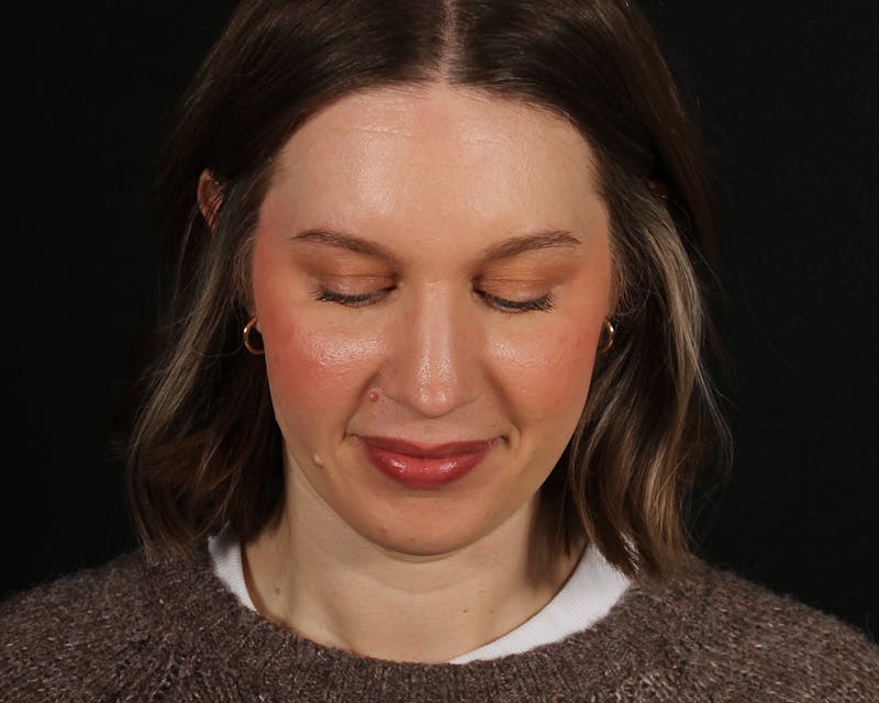 Rhinoplasty Female Before & After Gallery - Patient 378577 - Image 8