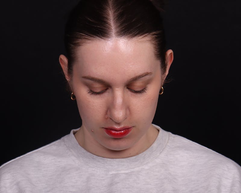 Rhinoplasty Female Before & After Gallery - Patient 378577 - Image 7