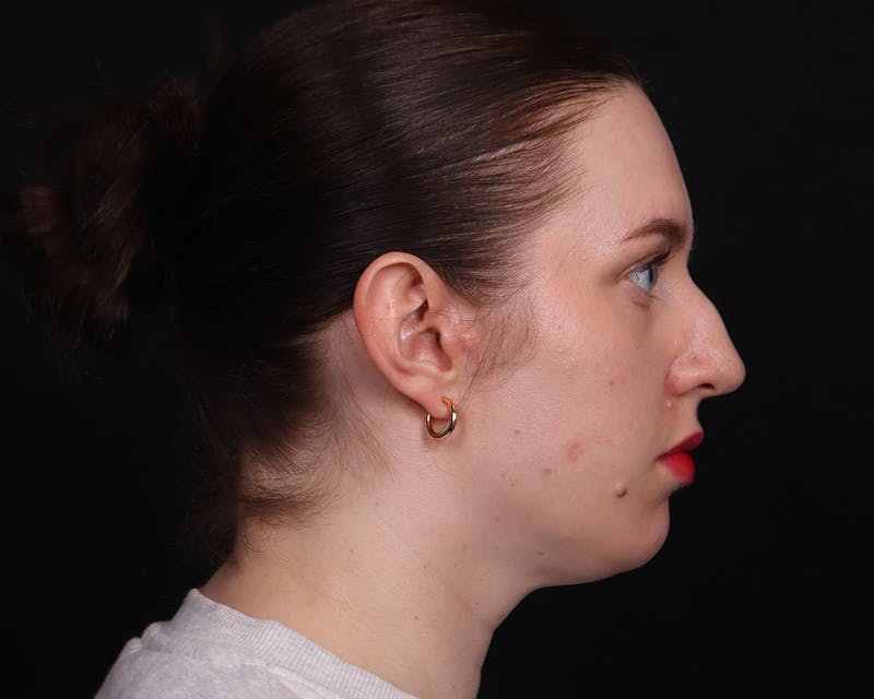 Rhinoplasty Female Before & After Gallery - Patient 378577 - Image 13
