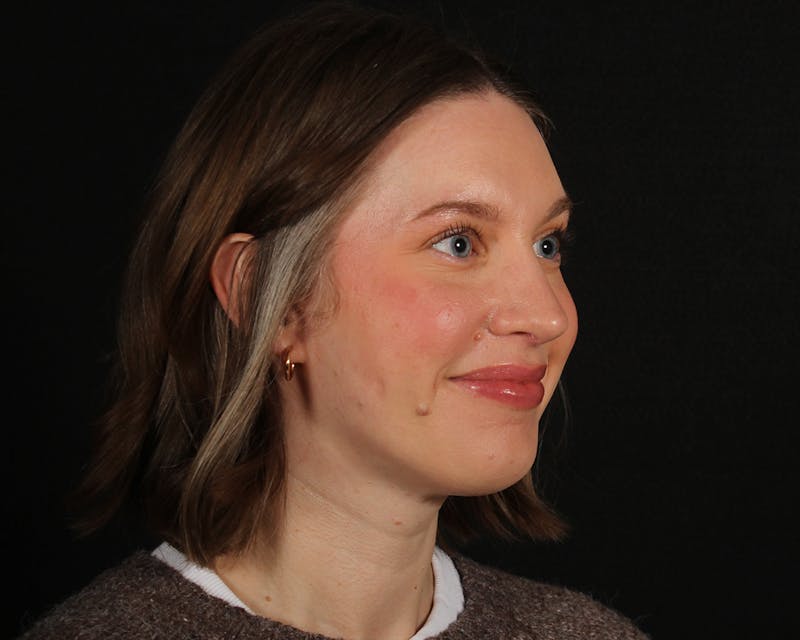 Rhinoplasty Female Before & After Gallery - Patient 378577 - Image 12