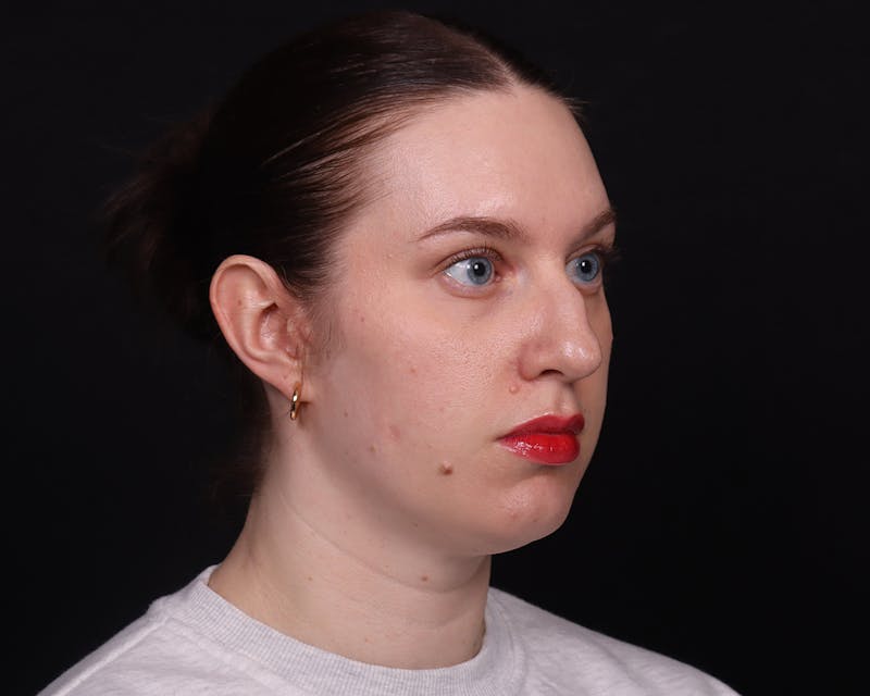 Rhinoplasty Female Before & After Gallery - Patient 378577 - Image 11